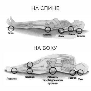 риск пролежней у лежачего