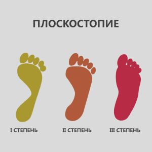 Степени плоскостопия